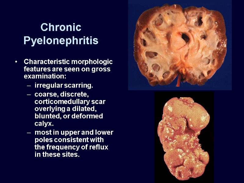 Chronic Pyelonephritis Characteristic morphologic features are seen on gross examination: irregular scarring. coarse, discrete,